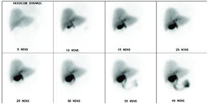 hepatobiliary scan